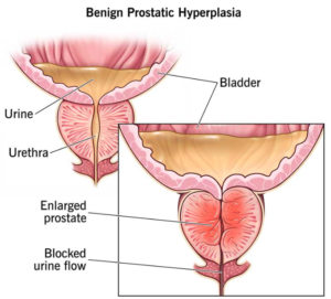Benign Prostatic Hyperplasia (BPH) occurs when the prostate enlarges and presses against the urethra, restricting urine flow.