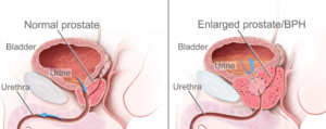 Benign Prostatic Hyperplasia (BPH) occurs when the prostate enlarges and presses against the urethra, restricting urine flow.