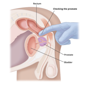 Prostatitis symptoms and prostate inflammation diagram