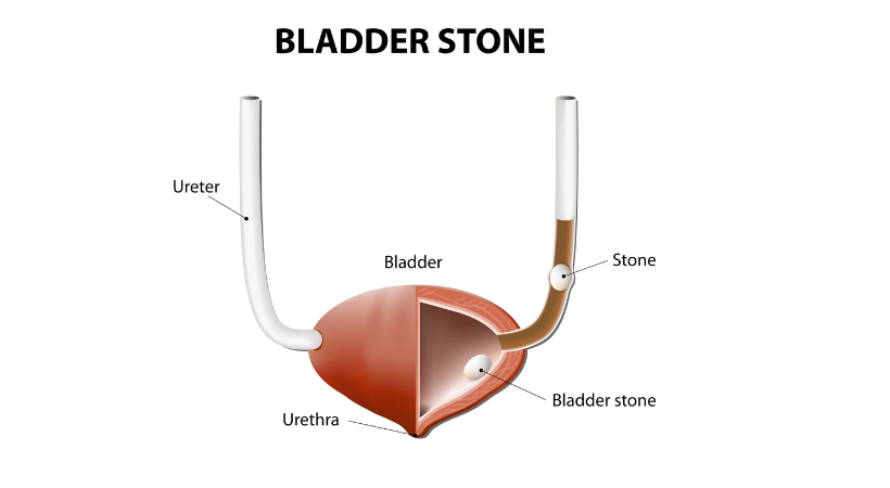 Bladder-Stone