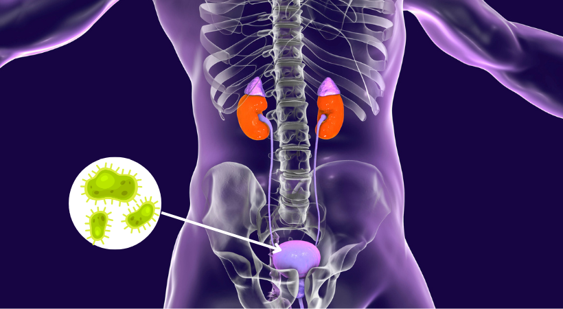 Bladder-infection