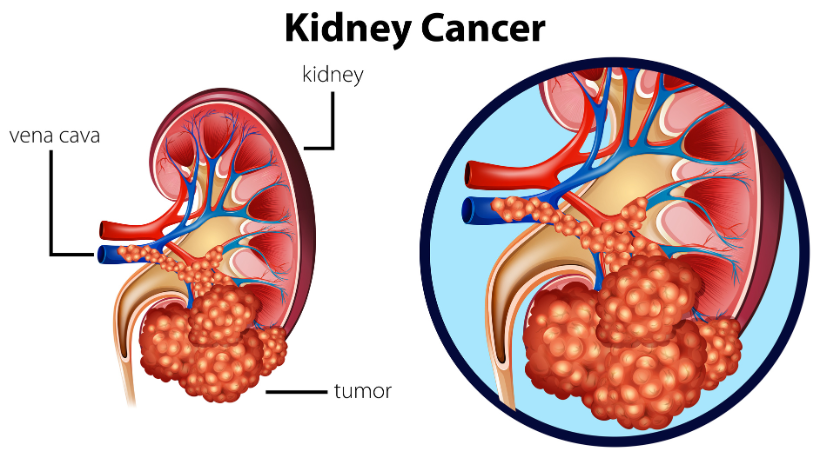 Kidney-cancer