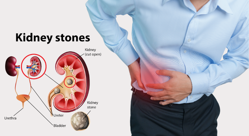 Kidney-stones
