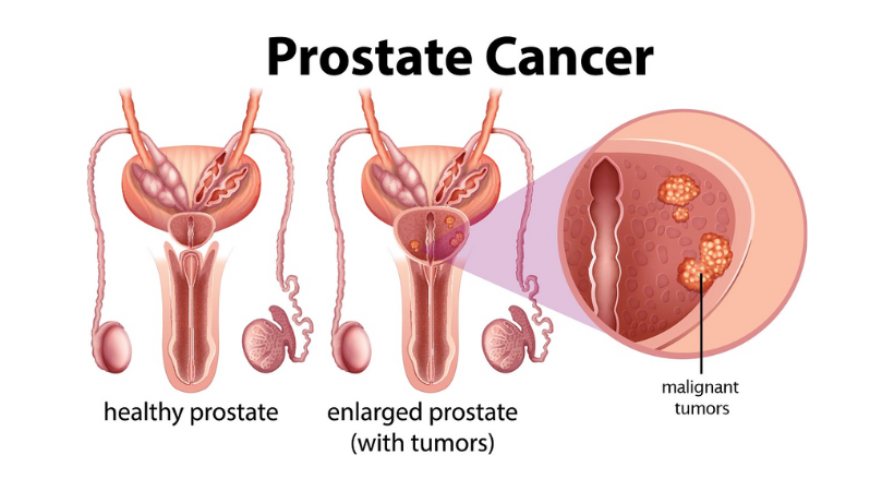 Prostate-cancer