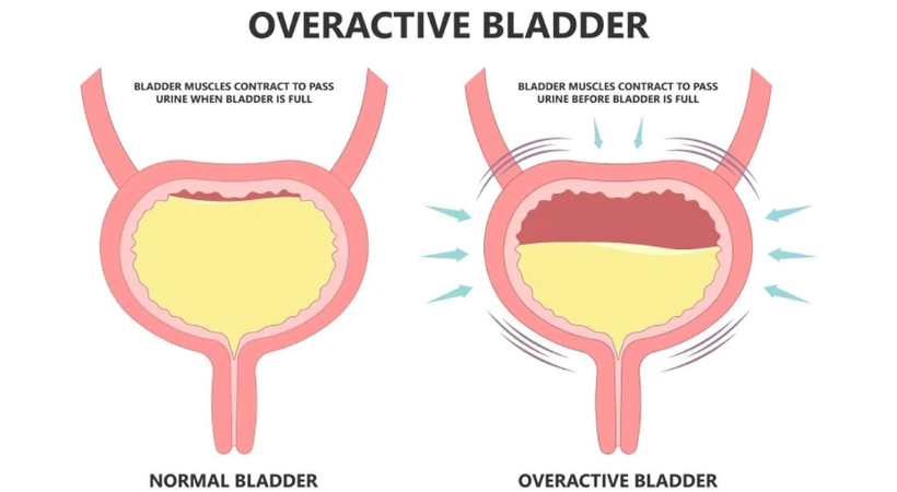 Overactive-bladder
