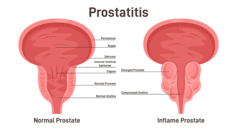 Prostate Treatment In Pune