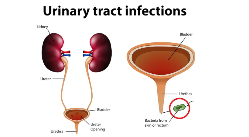 Urinary-tract-infection
