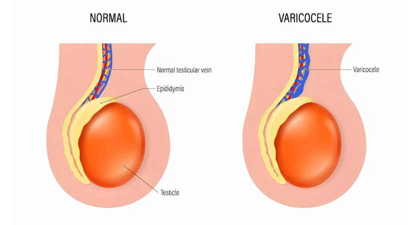 Varicocele Treatment in Pune